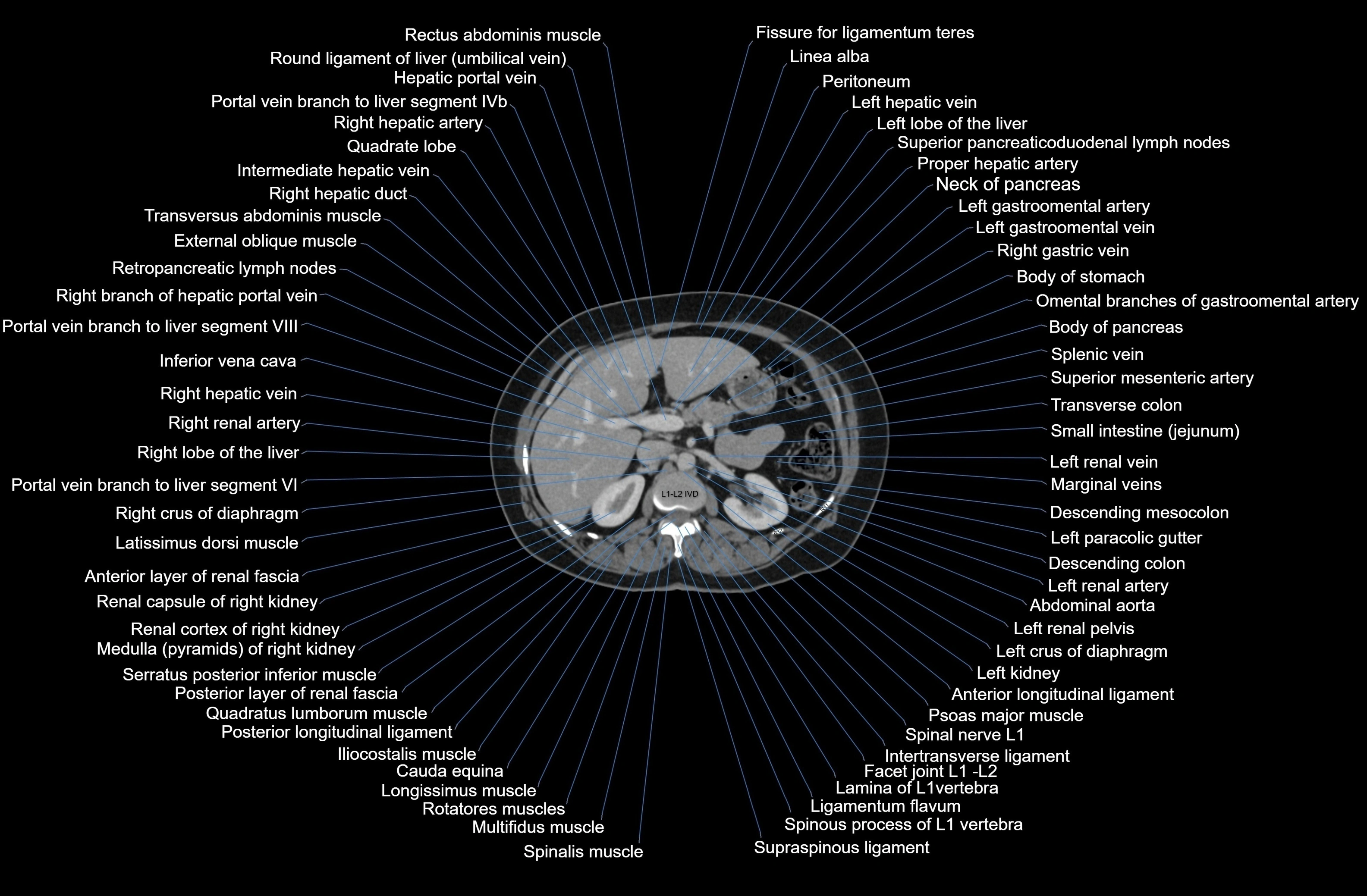 CT Abdomen axial cross sectional anatomy labelled radiology image-00029.webp
